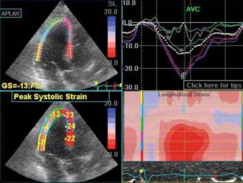 echocardiogram 2