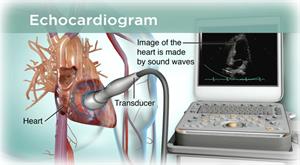 echocardiogram